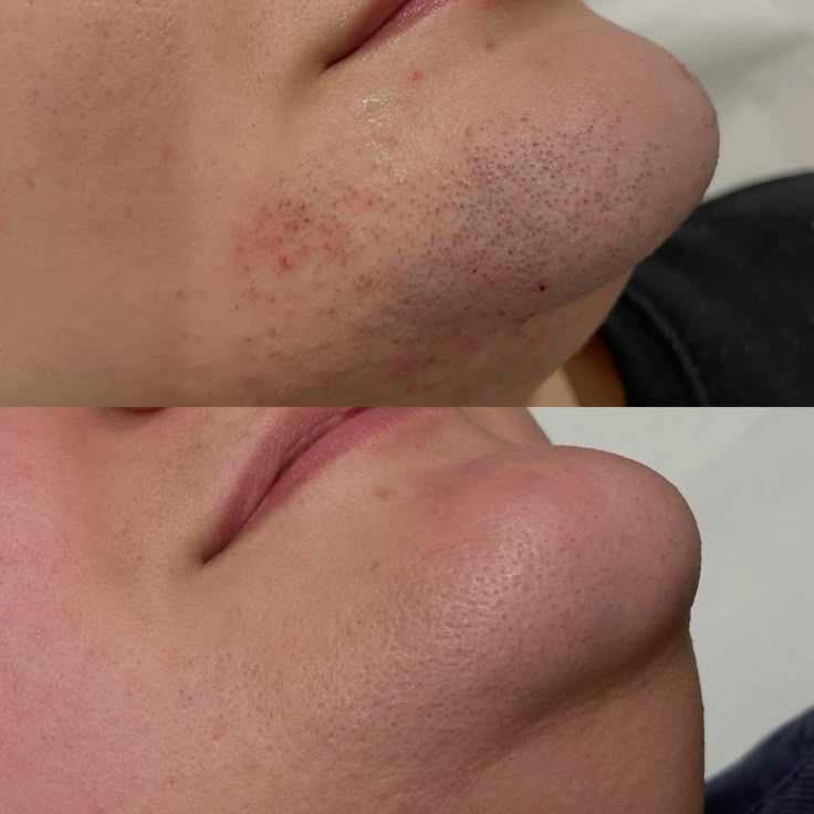 <h1><strong>Sichtbar reduziertes Haarwachstum in 30 Tagen</strong></h1>