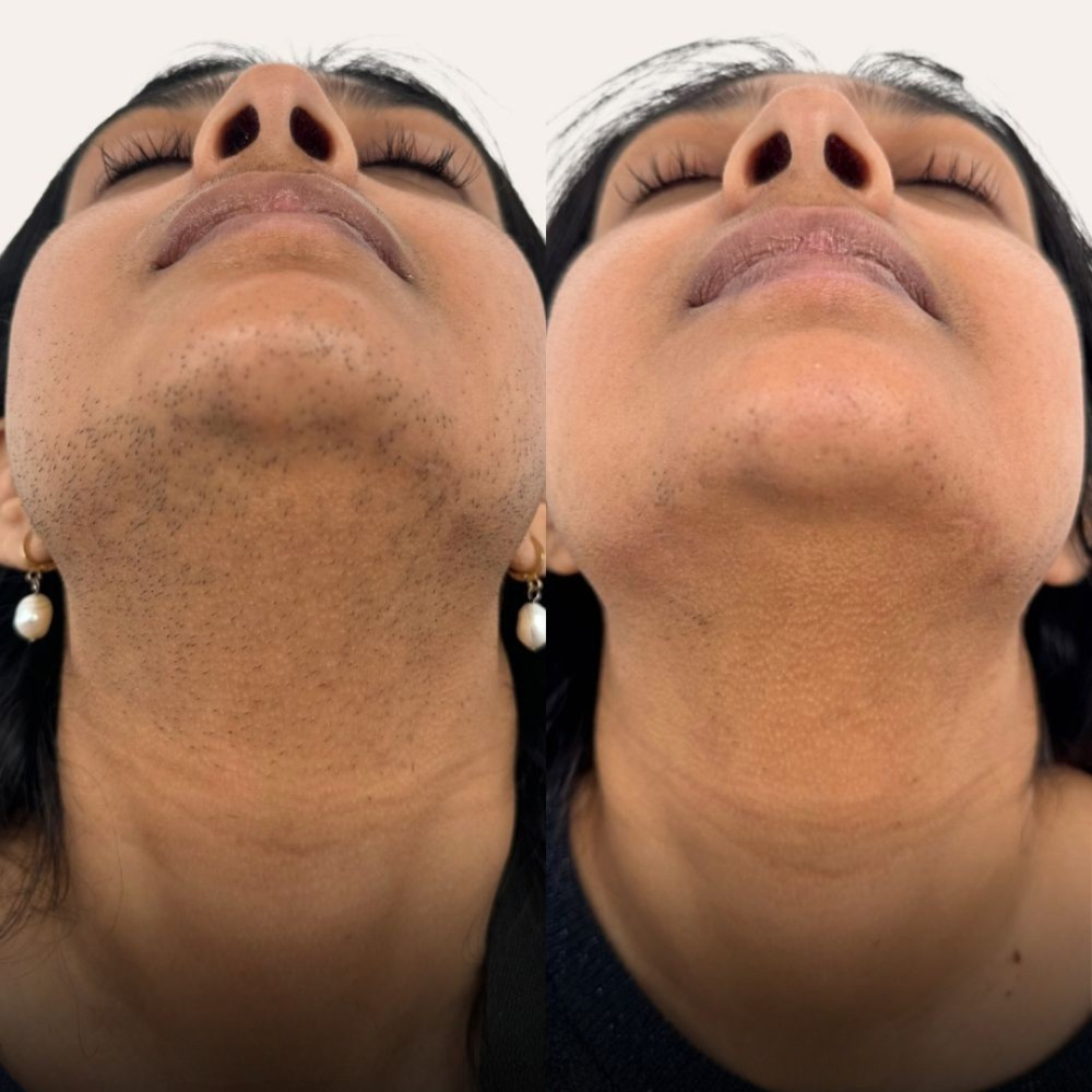 <h1><strong>Sichtbar reduziertes Haarwachstum in 30 Tagen</strong></h1>